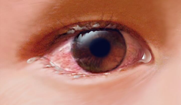 blocked tear duct or conjunctivitis? how to tell